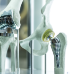 Finding Relief After Total Hip or Knee Replacements